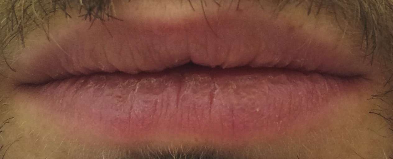 Does Chapstick Work?