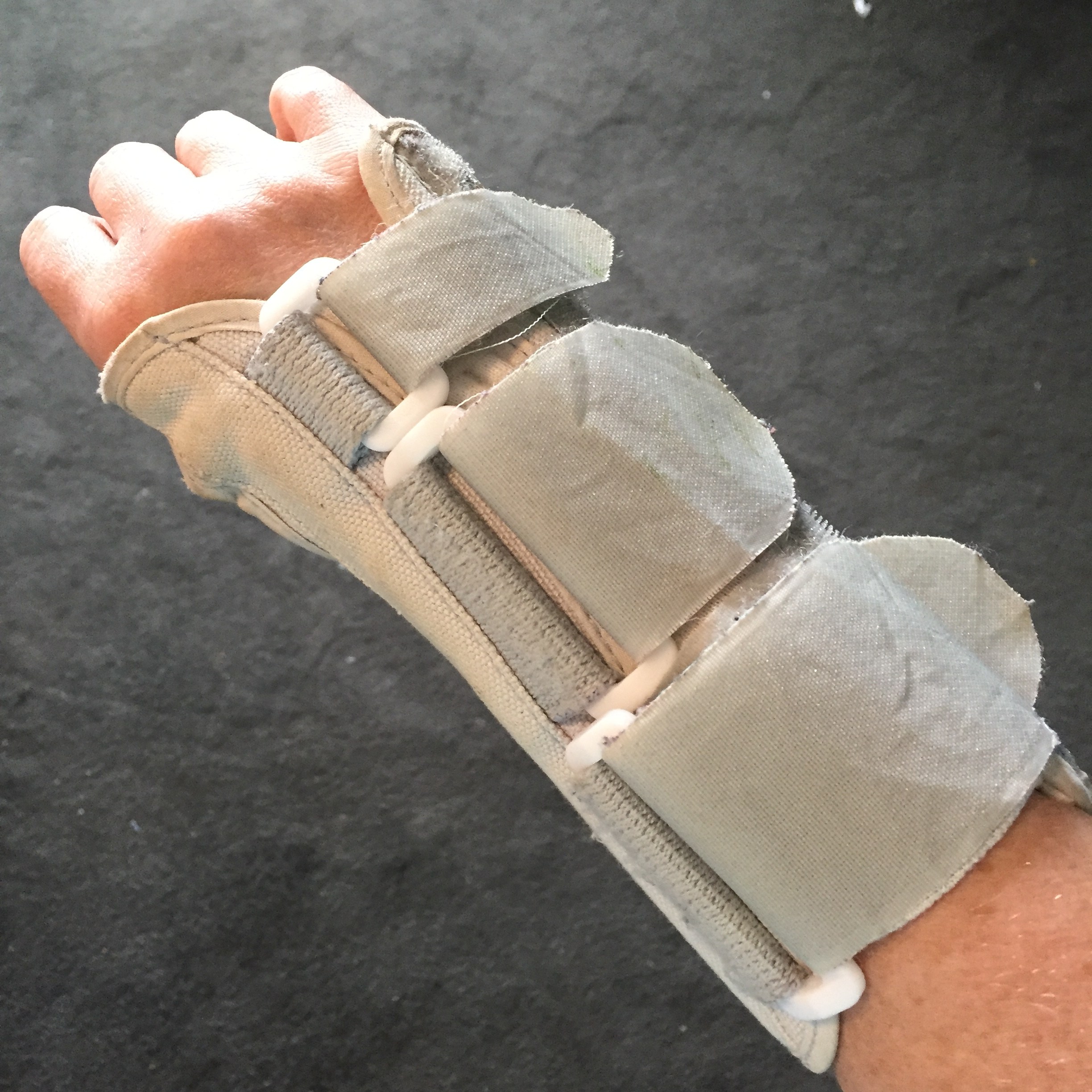 Ganglion Cyst Removal / Excision Recovery Pictures Jenny Smith