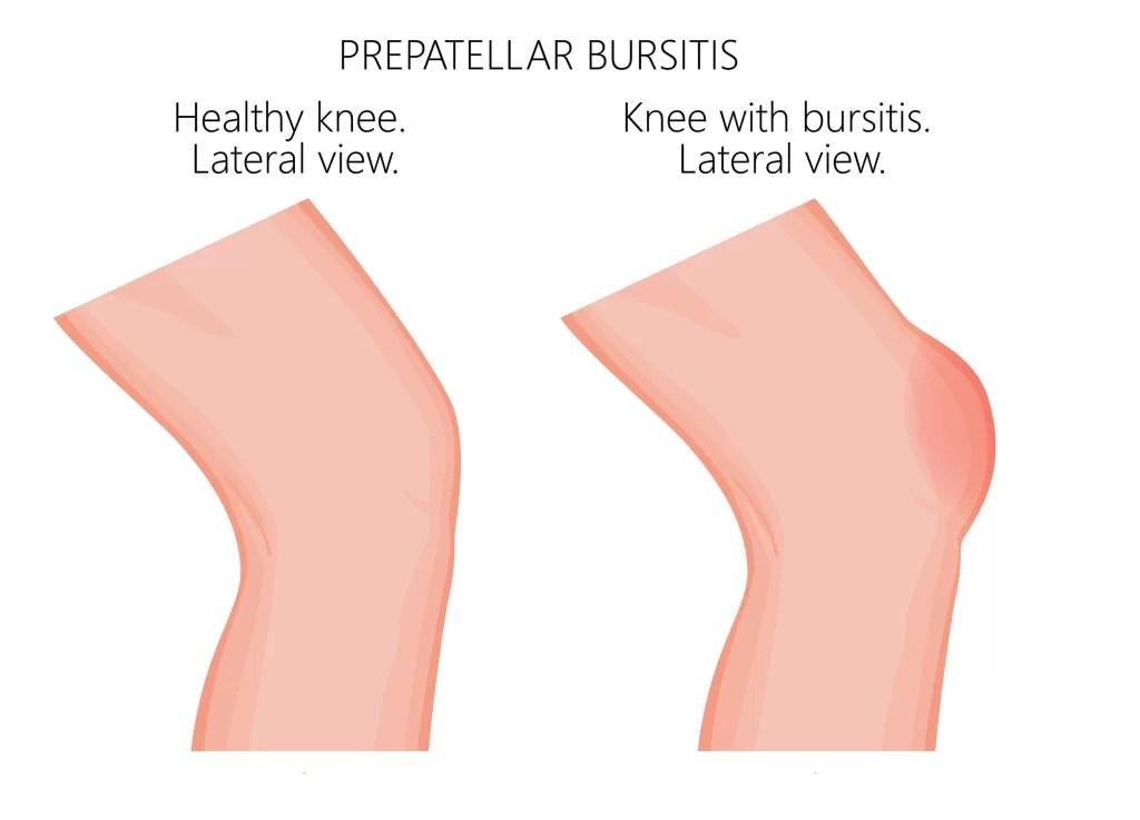 Knee Bursitis 7 Treatment Tips Jeremy Burnham, MD