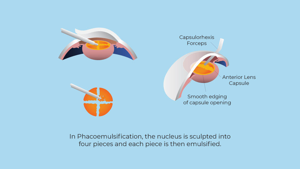 Jerry Tan Eye Surgery Singapore How Is Cataract Surgery Done