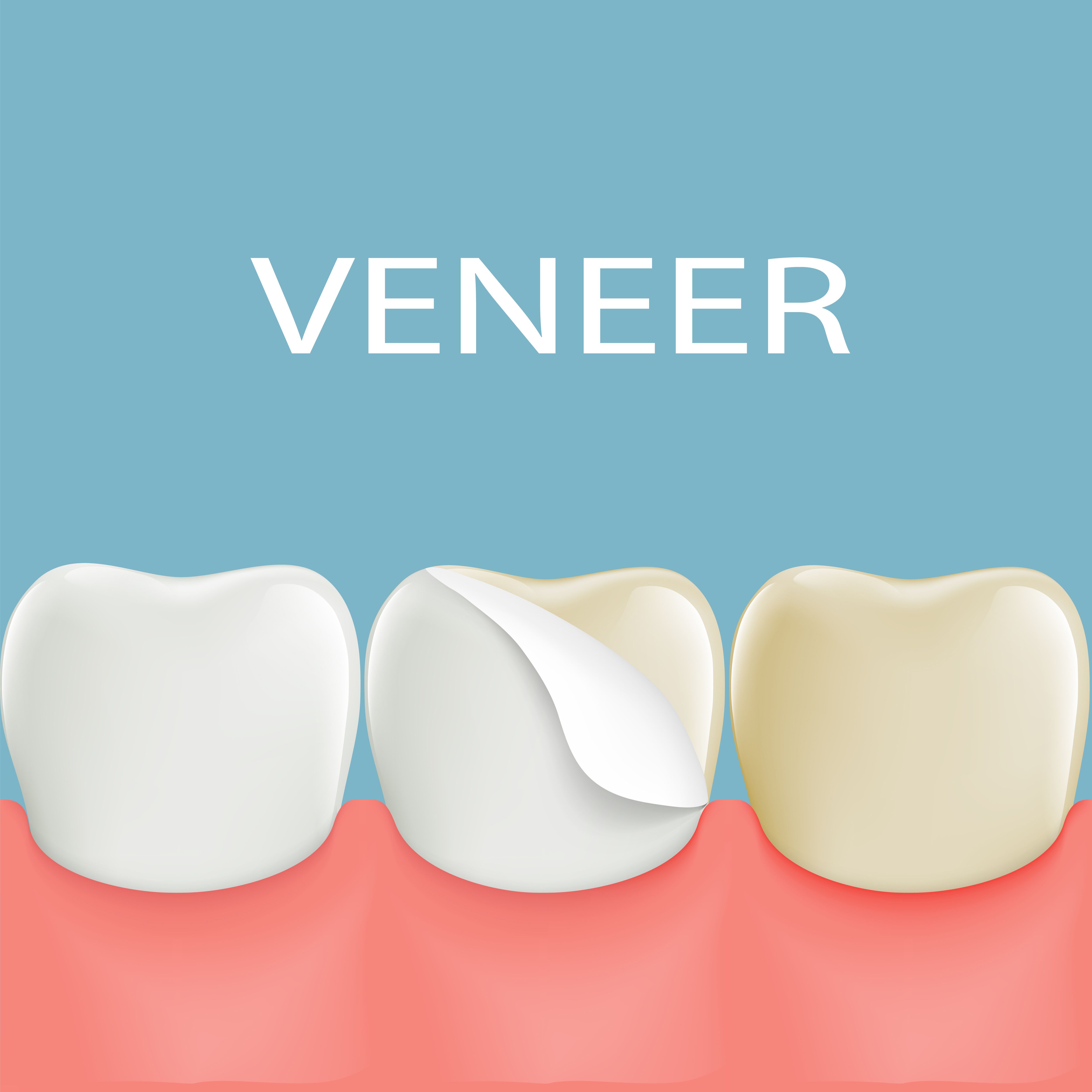 veneer diagram Skylands Dental of New Jersey Blog