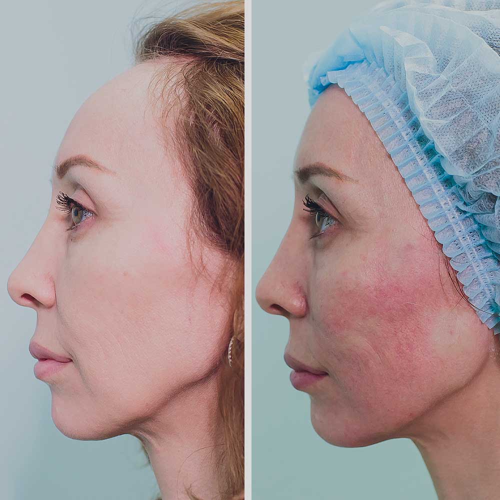 Thread Lift Cheshire Joanne Willcox Clinics