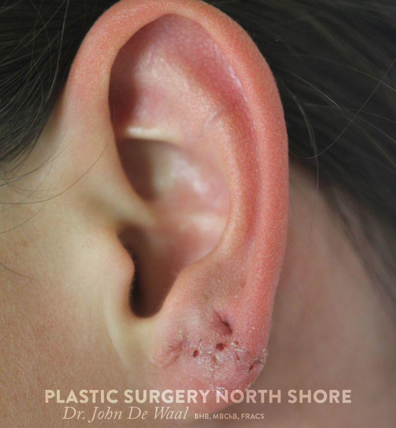 Earlobes Plastic Surgery North Shore