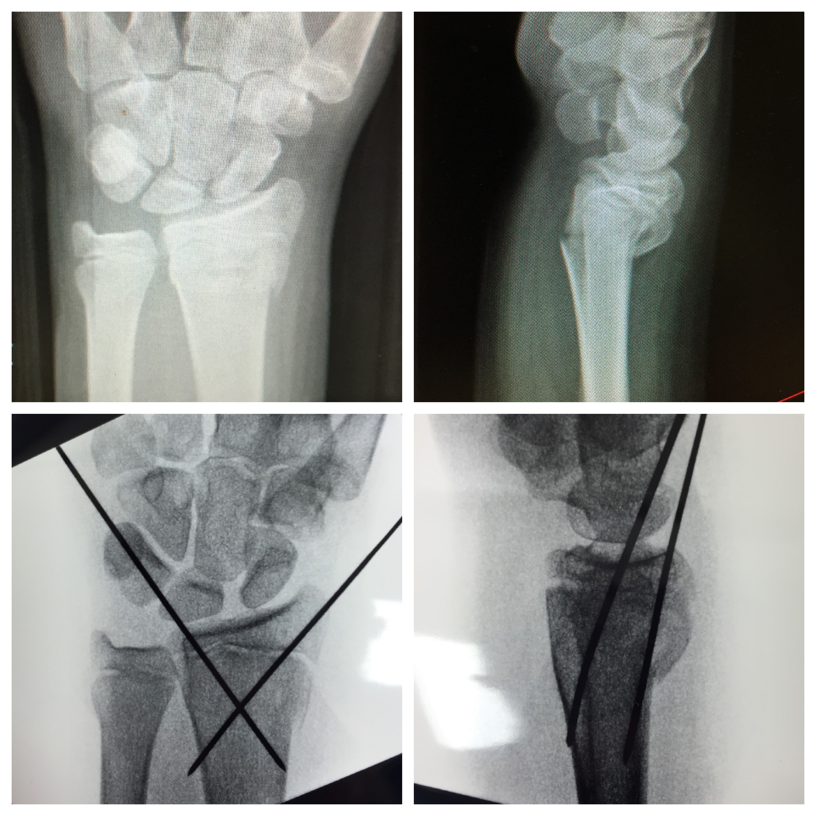 Broken Wrist Surgery for Adults and Kids in Raleigh NC John Erickson. MD