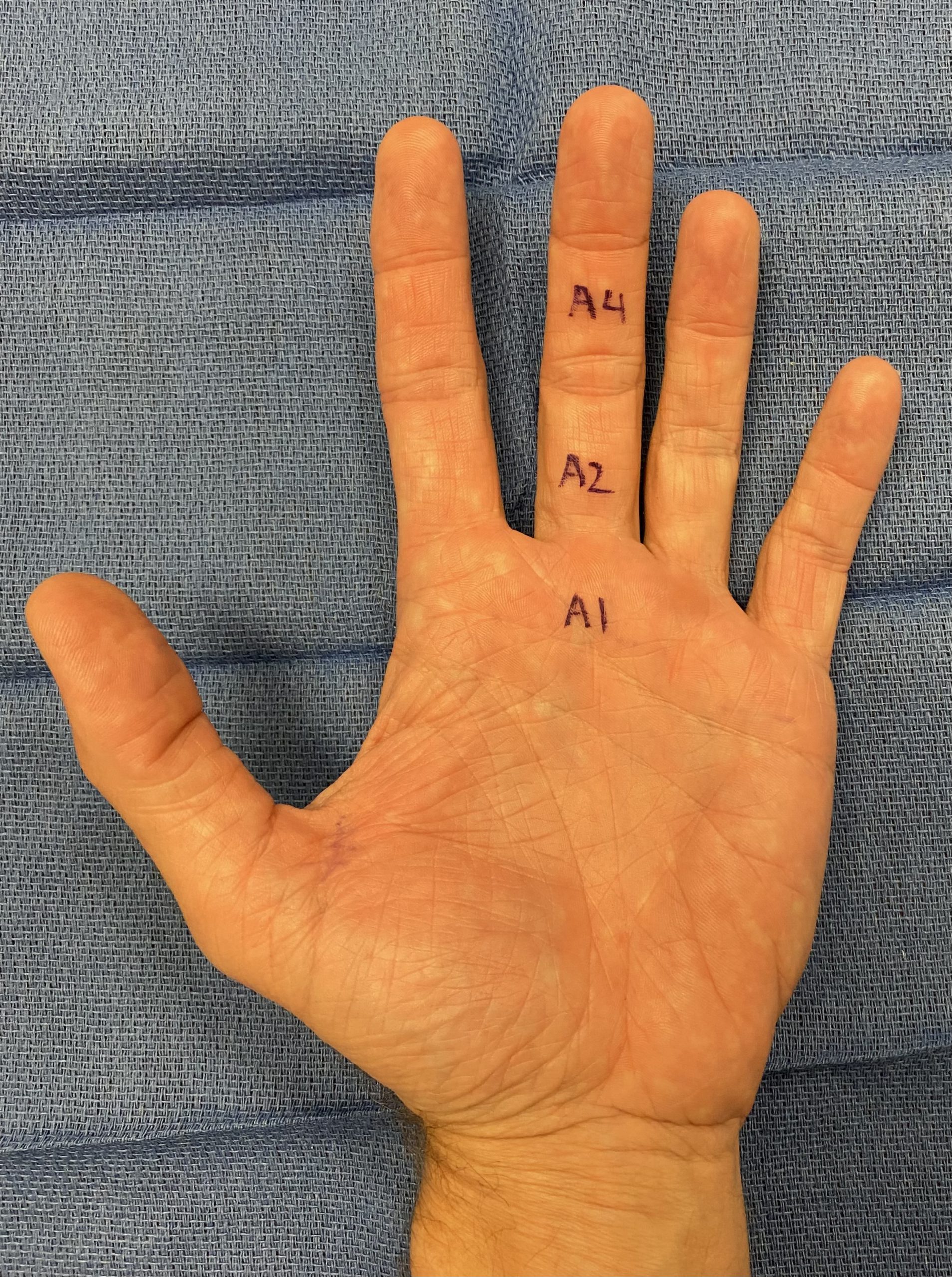 What is a Trigger Finger? Dr. Erickson explains