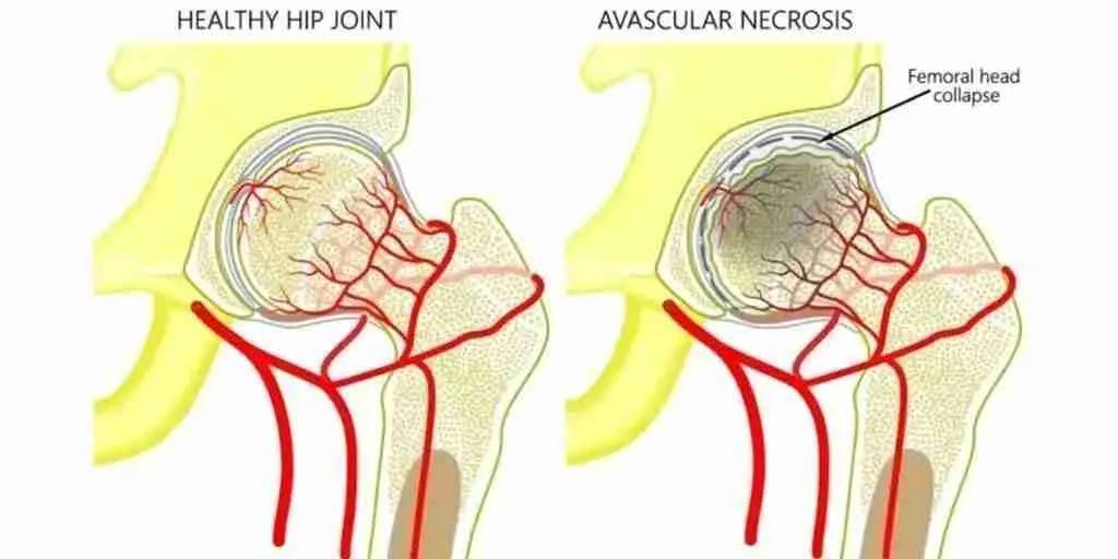 Hip Avascular Necrosis Preservation & Replacement