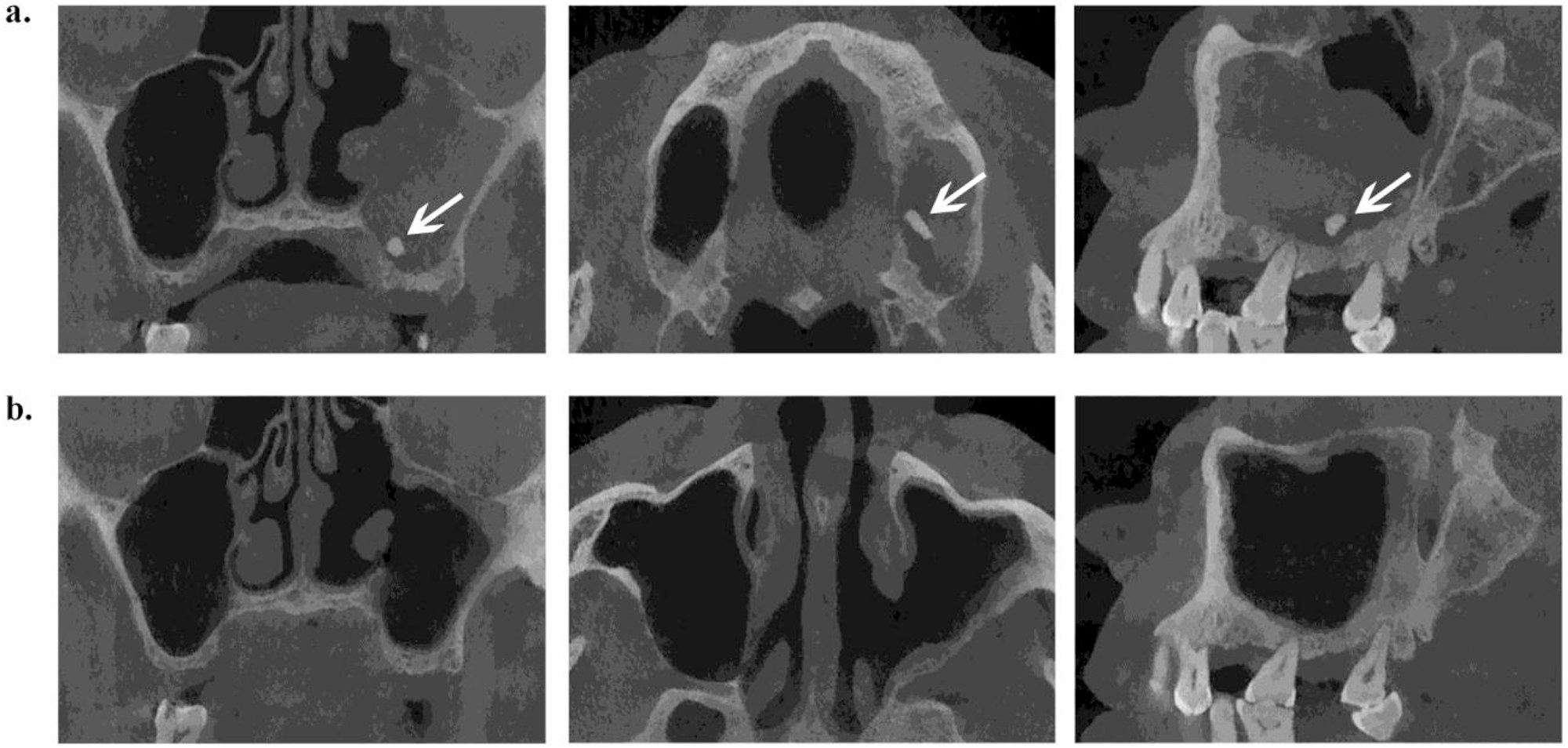 Teeth roots displacement in the maxillary sinus characteristics and management Journal of