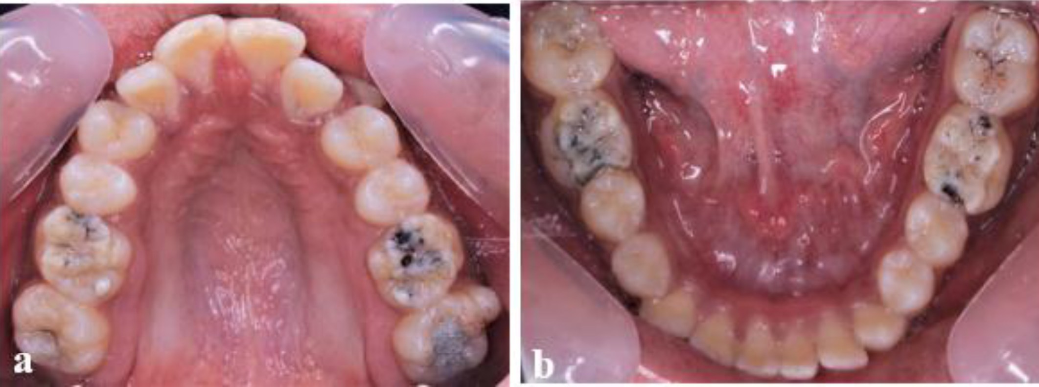 Nonsyphilitic moon molars A rare intraoral phenomenon Journal of
