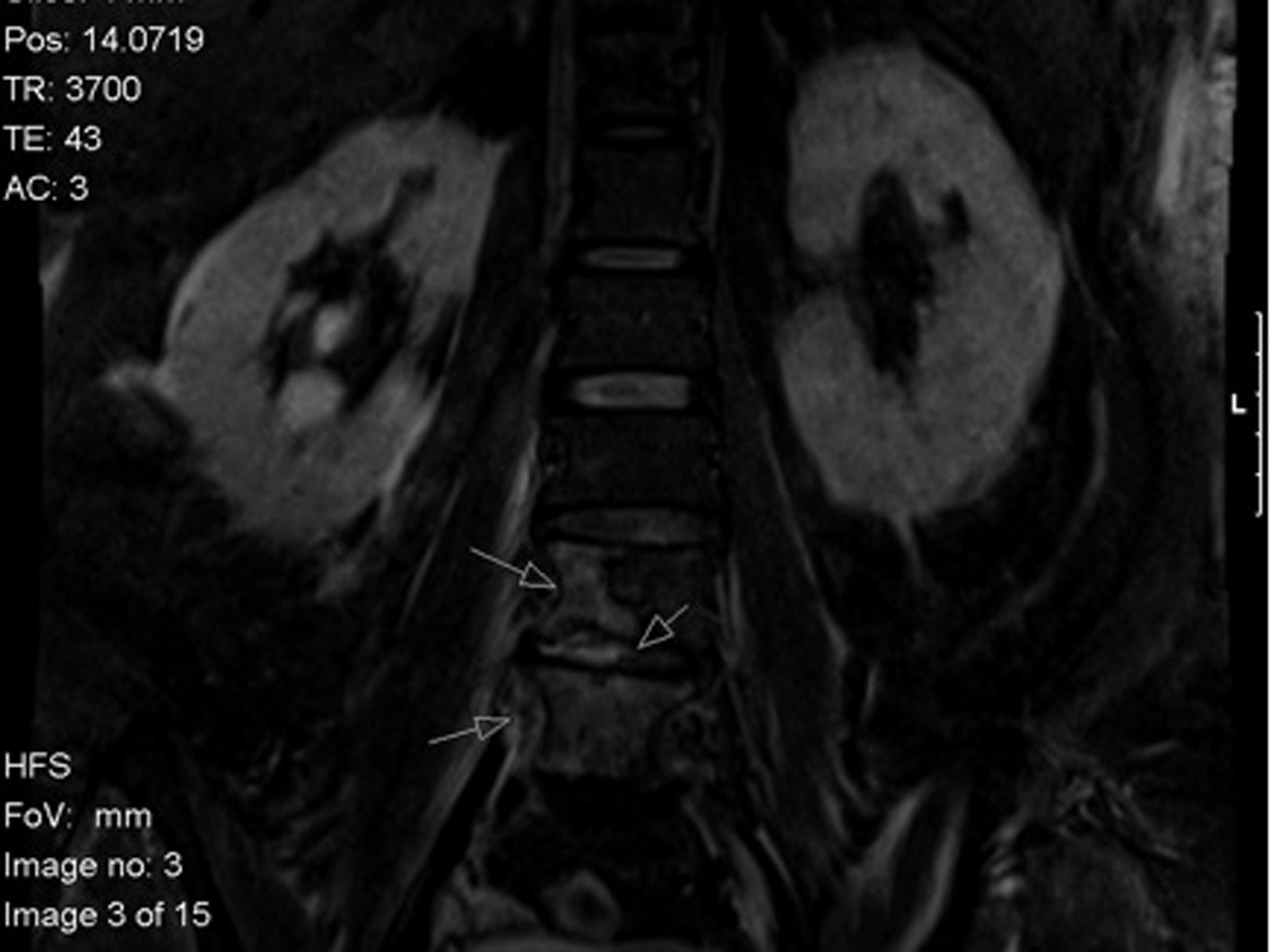 Unrelenting Lower Back Pain in an Uncontrolled Diabetic Patient With an