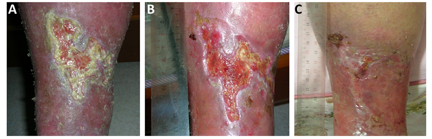 Treatment of Chronic Wounds With the SilverContaining Activated Carbon