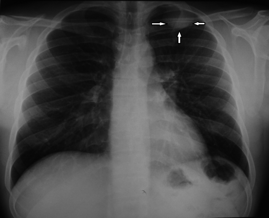 Thoracoscopic Resection of an Intercostal Neurinoma Agrafiotis
