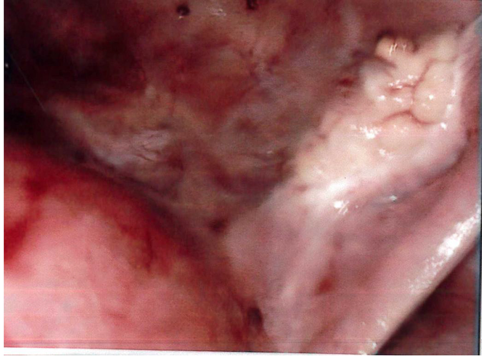 A Case of Ruptured Ovarian Ectopic After Embryo Transfer With Low Serum
