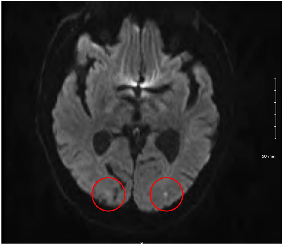A Case Of Transient Loss Of Vision Following Coronary Angiography: Etiology, Investigation And Management | Mcelnea | Journal Of Medical Cases