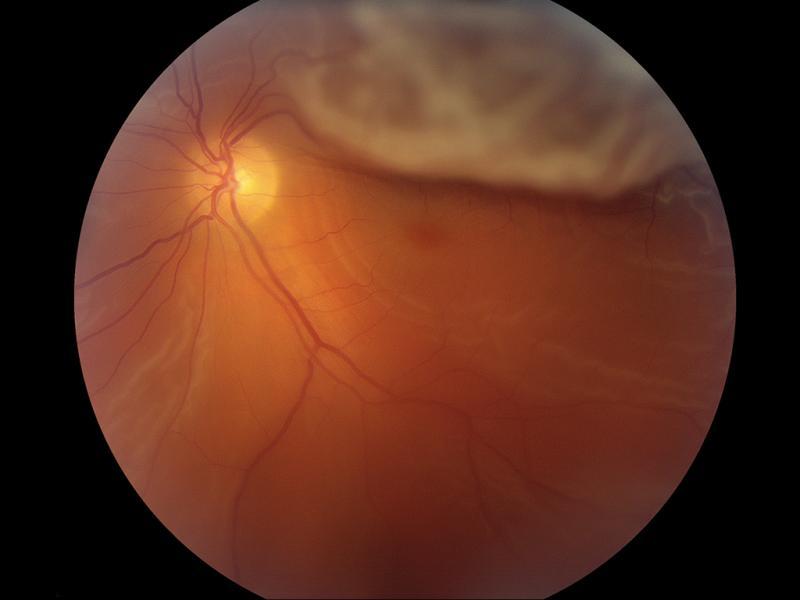 Flashes of Light, Floaters, and Blurred Vision JUCM Images Challenge