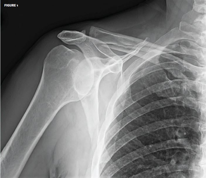 Unable to lift arm over head Archives Journal of Urgent Care Medicine