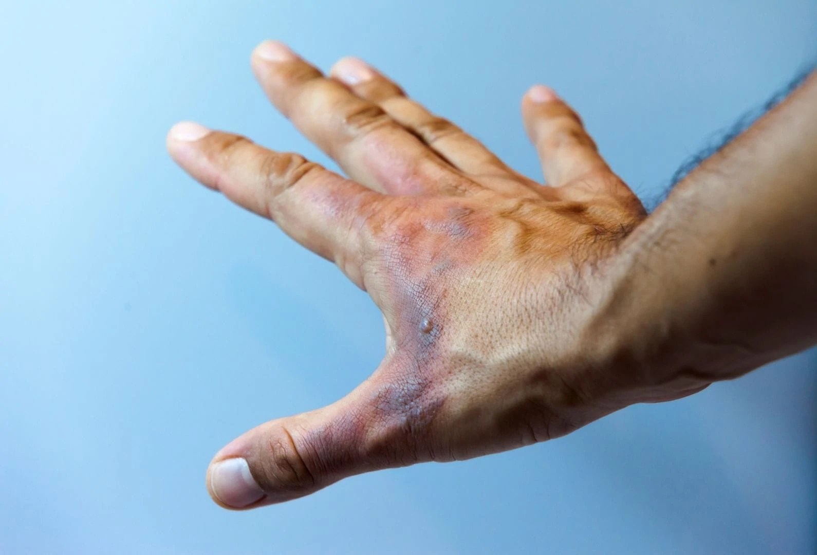 Como tratar queimaduras Clínica Dra. Juliana Toma