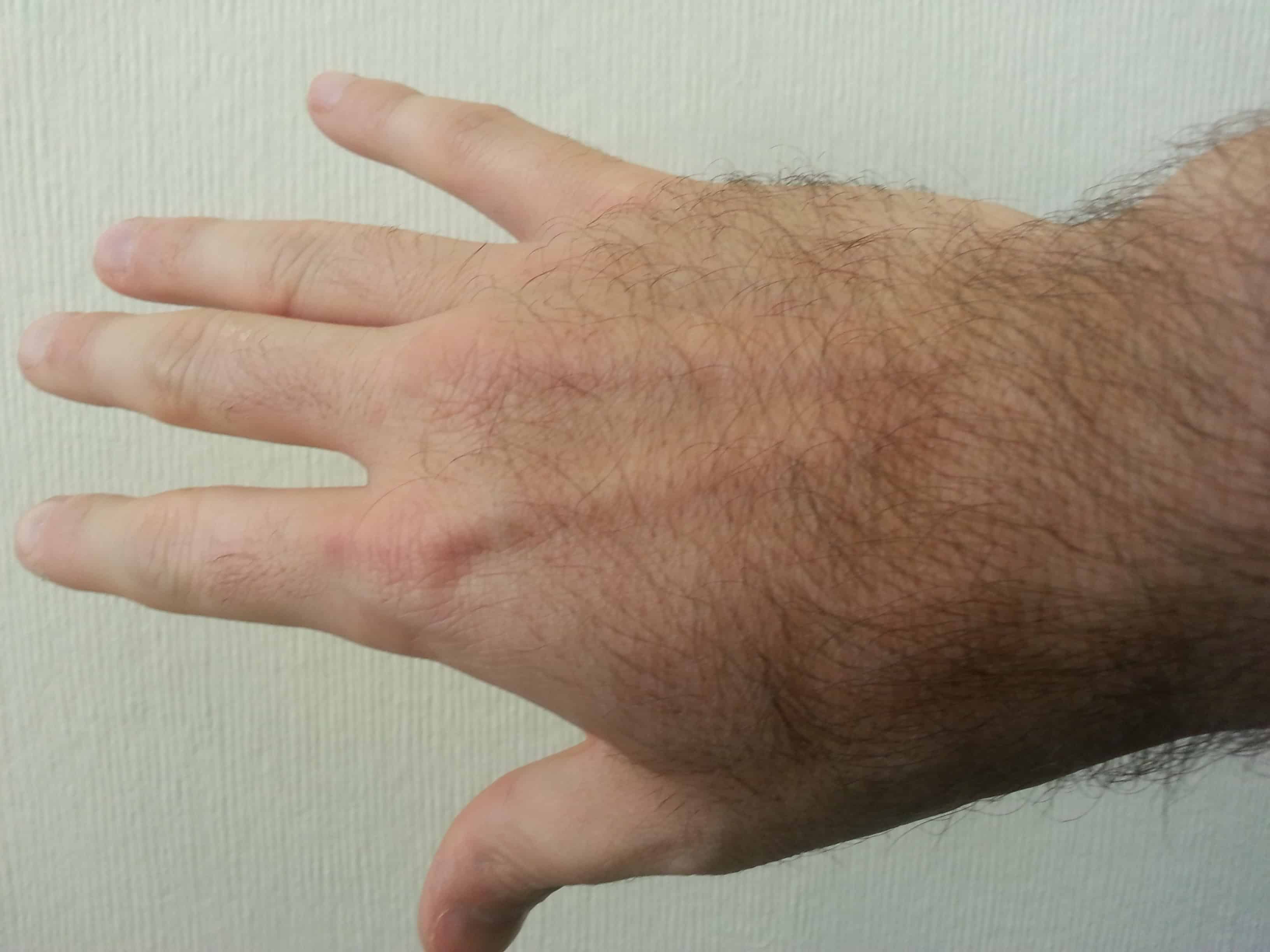 125,000 Settlement for Hand Surgery from Miami Car Crash