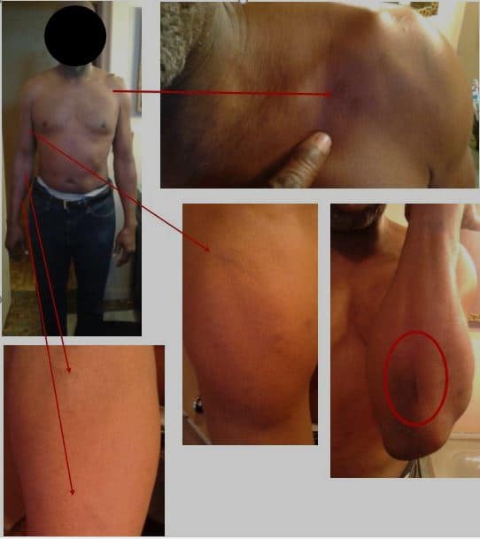 10,000 Settlement for Small Scars, Shoulder Pain from Truck Accident