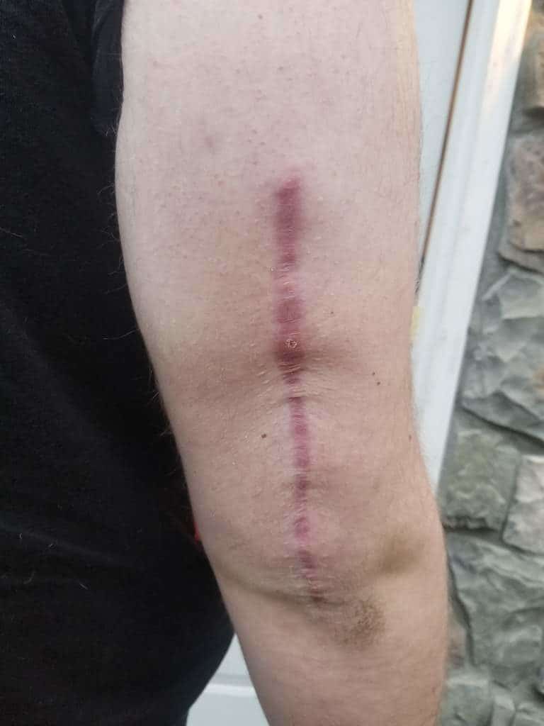 Broken Arm (Humerus) Settlements Averages, Car Accidents, Compensation