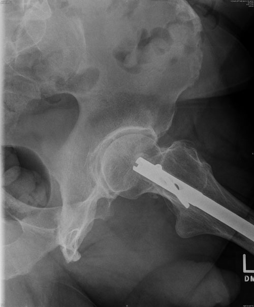 XRays from Car Accident