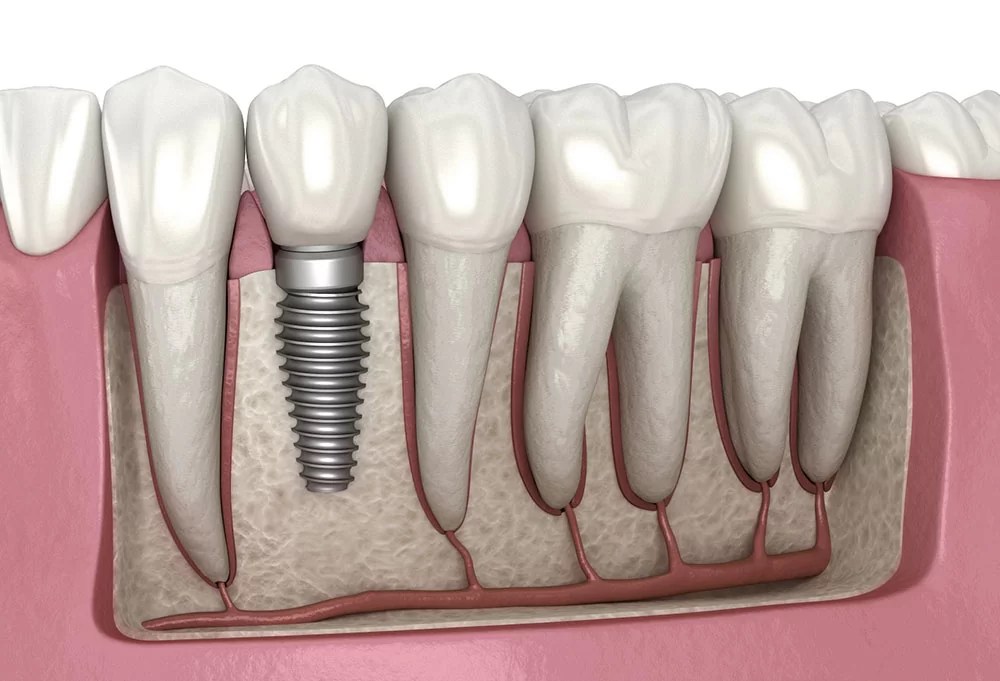 Are Dental Implants Right For Me? Kangaroo Point Dental