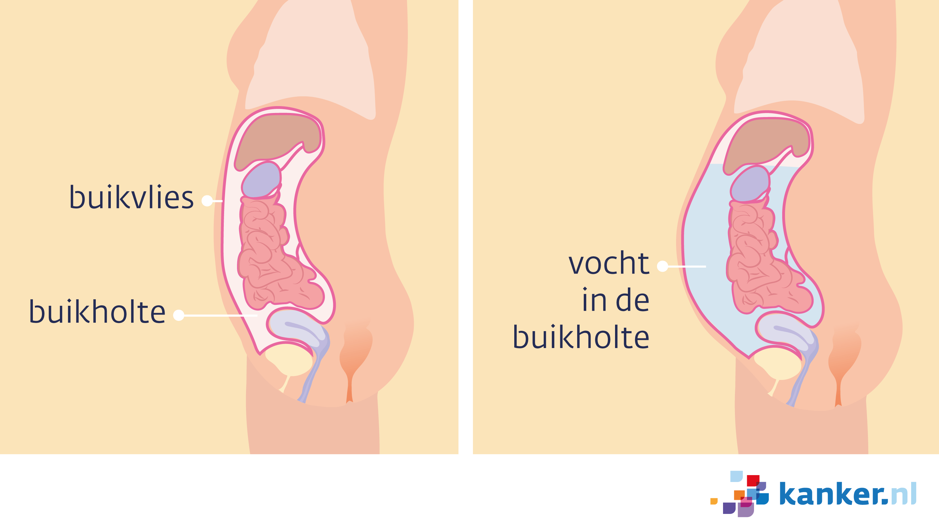 Vocht In Buikholte / Ascites