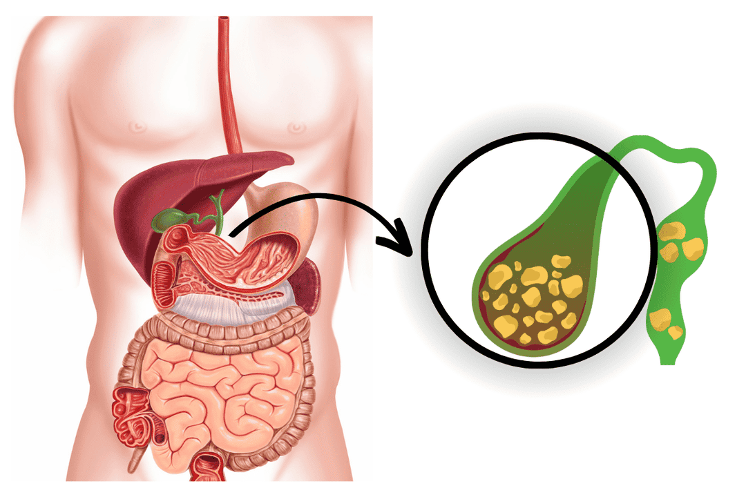 Gallstone Treatment in Ayurveda, Ayurvedic Medicine at Karma Ayurveda