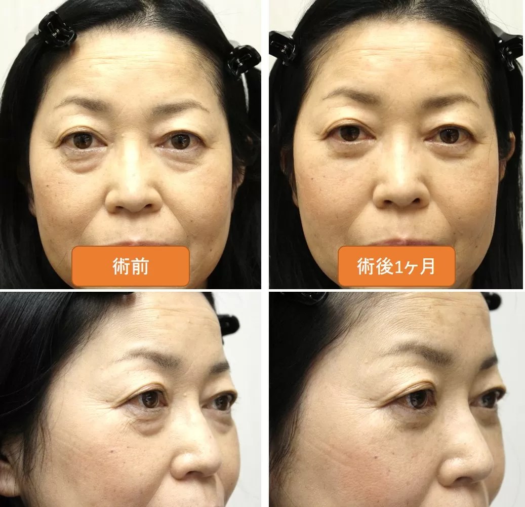 目の下のくま（眼窩脂肪ヘルニア） 眼形成手術専門医師・鹿嶋友敬｜バセドウ病・顔面神経麻痺・眼瞼下垂・逆さまつ毛