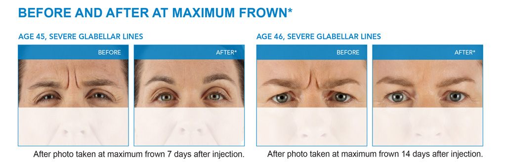 BOTOX St. Petersburg Dysport Clearwater, FL Injectable Fillers