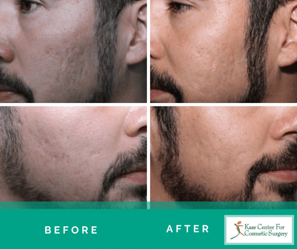 Acne Scar Treatment in St. Petersburg & Clearwater, FL Tampa Bay