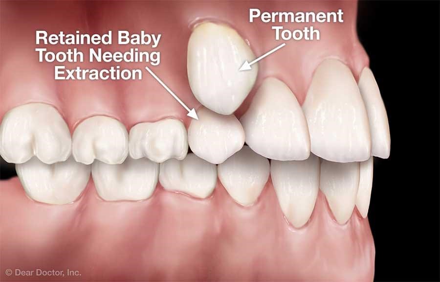 Dental Extractions in Rockledge, FL Serenity Family Dentistry
