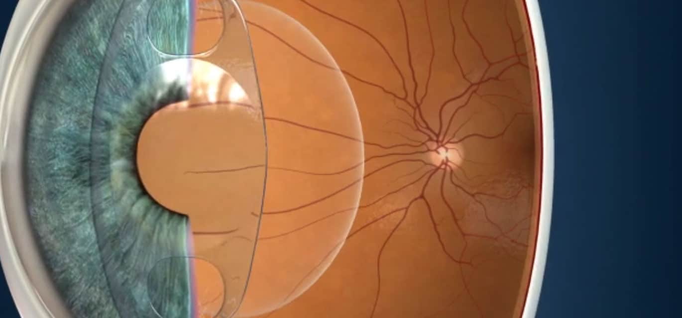 ICL Surgery Katzen Eye Care Boynton Beach