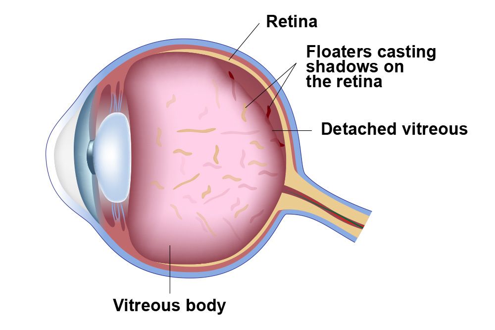 What Causes of Floaters and Flashes? Retina Associates Kansas City