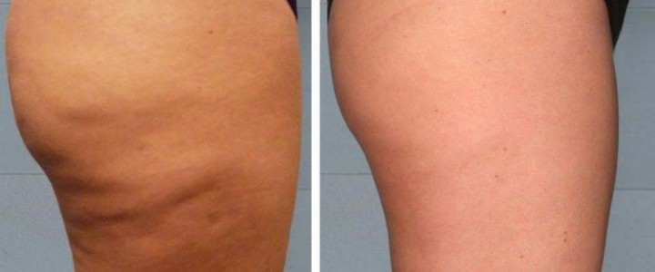 Olvídate de la celulitis Kebuena