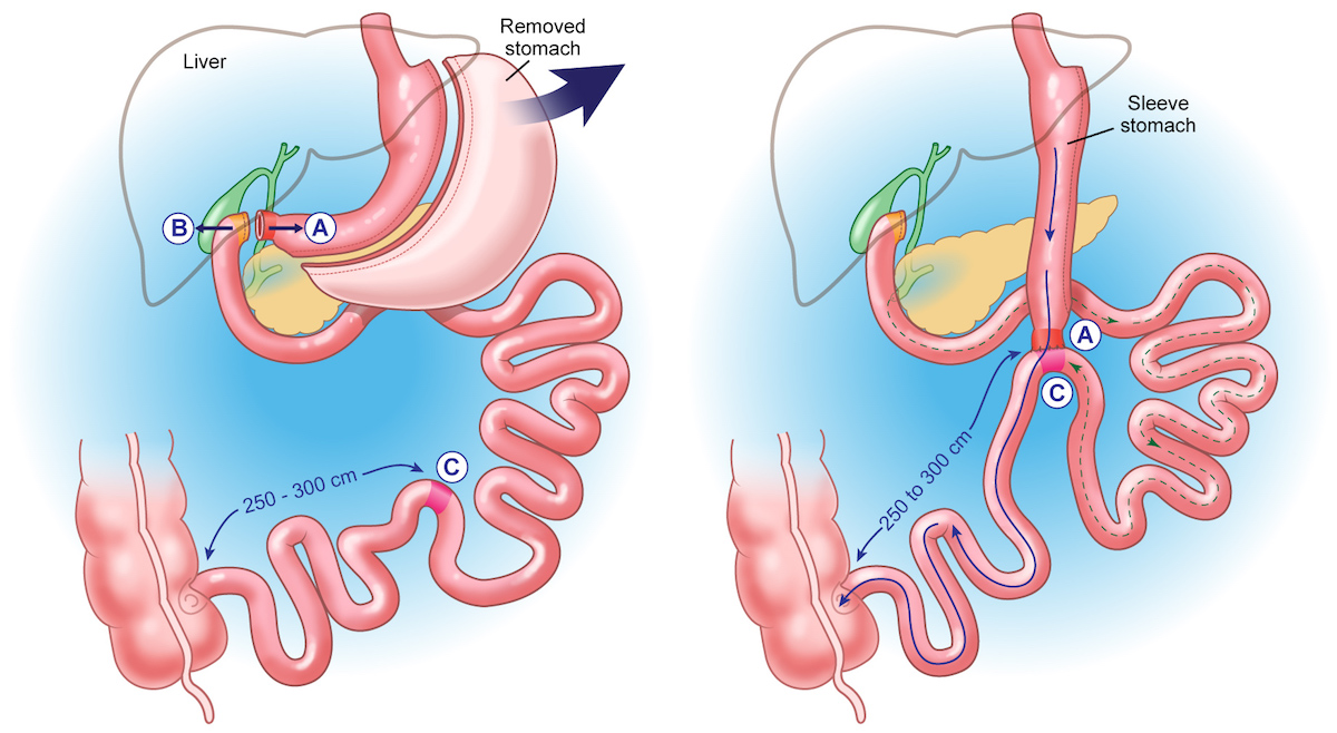 Duodenal Switch Surgery Dallas & Fort Worth Tx Cost,Diet,Risks&Results