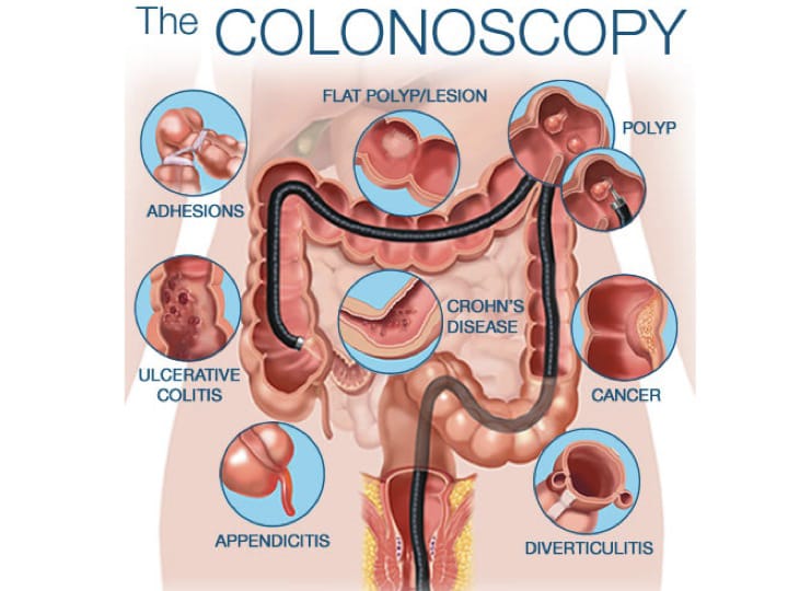 Colonoscopy Prashant Kedia MD Endoscopic Sleeve Gastroplasty