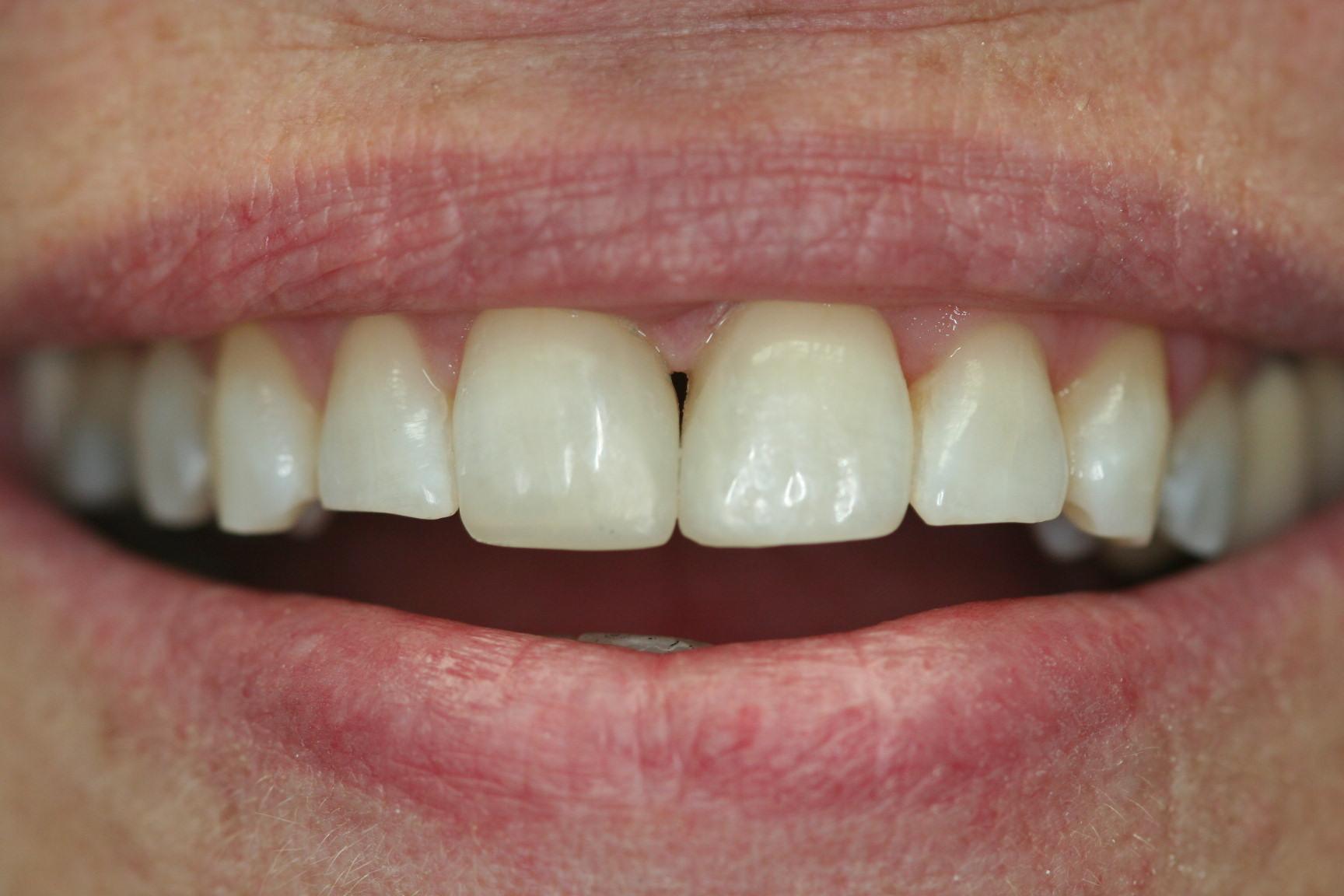 Porcelain Veneers or Bonding? » The Center for Cosmetic Dentistry