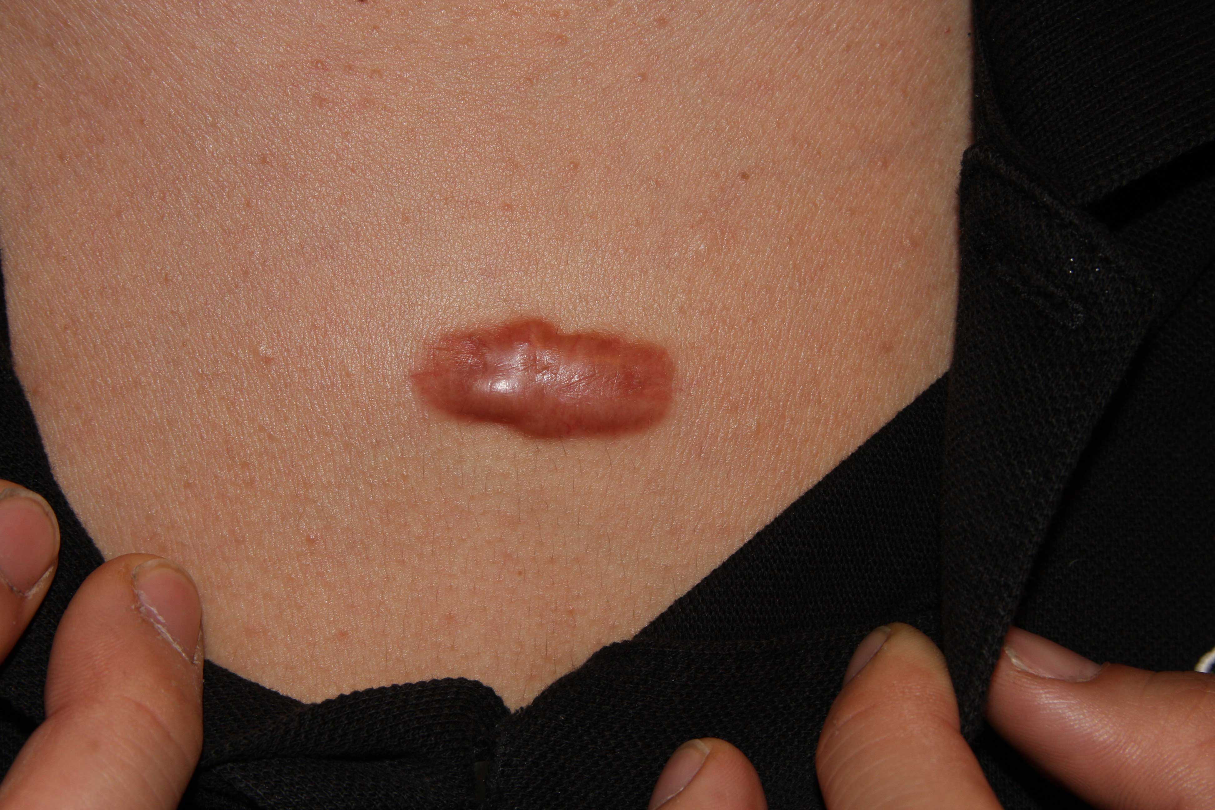 chest2 Keloid Removal Expert New York