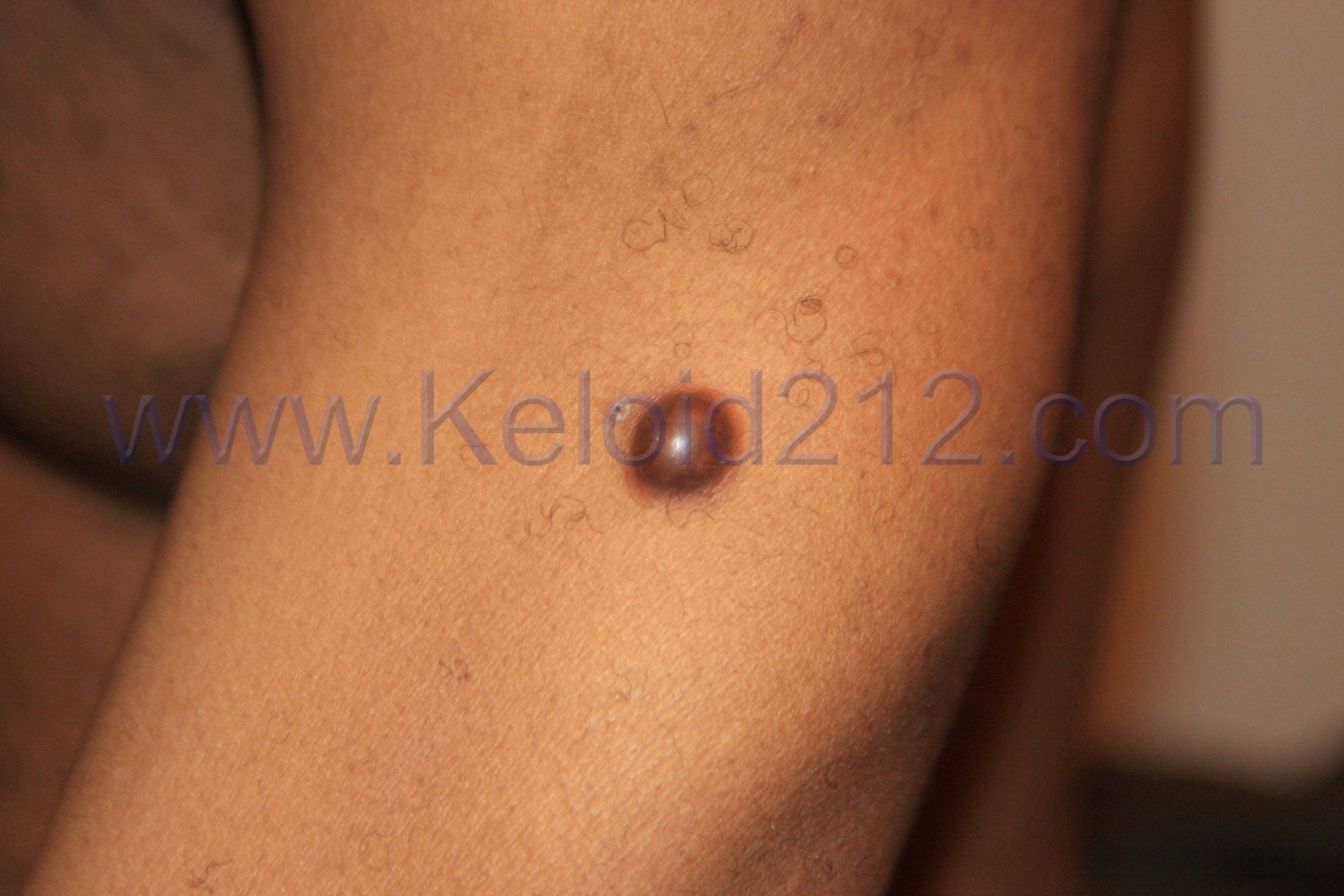 Nodular Keloids Keloid Removal Expert New York