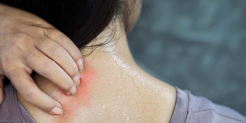 Skin Rashes? It's Time To Check Your Home's Water Quality