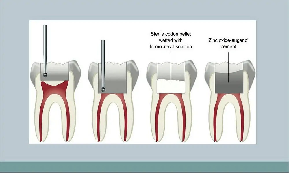 Pulp Therapy Kidodontica