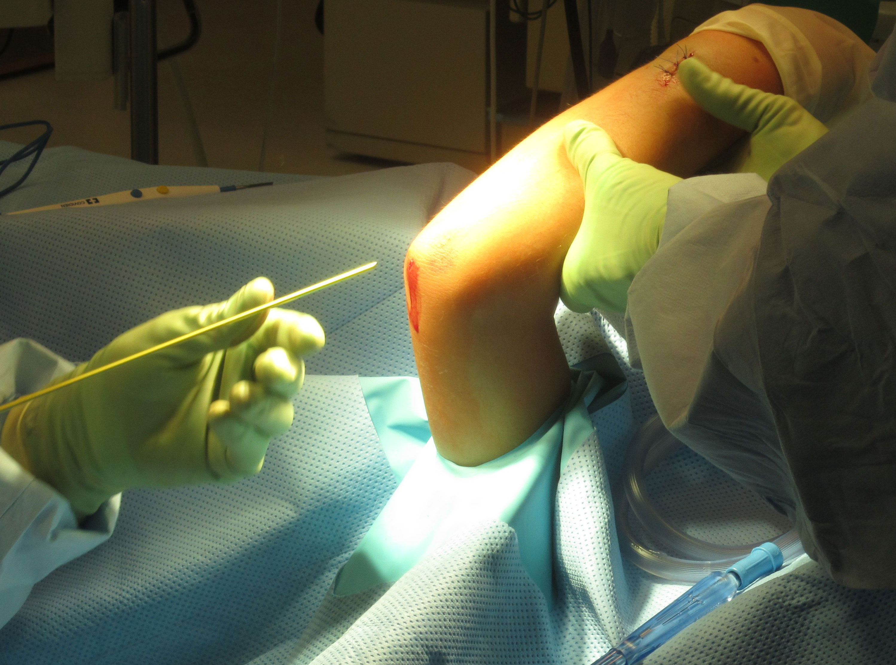 open forearm fracture treated surgically » forearm fracture