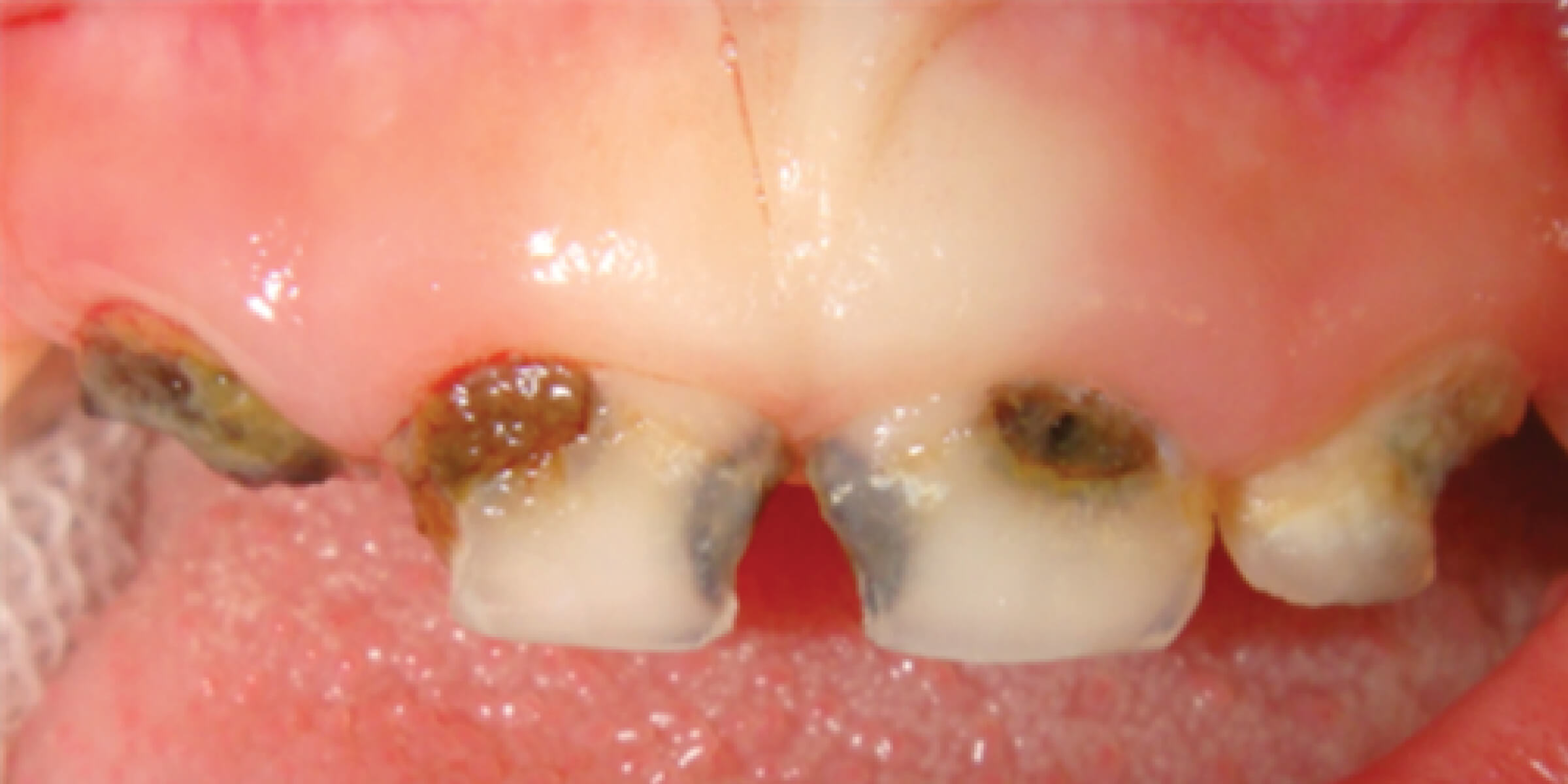 Zirconia Pediatric Crowns Kinder Krowns All Ceramic