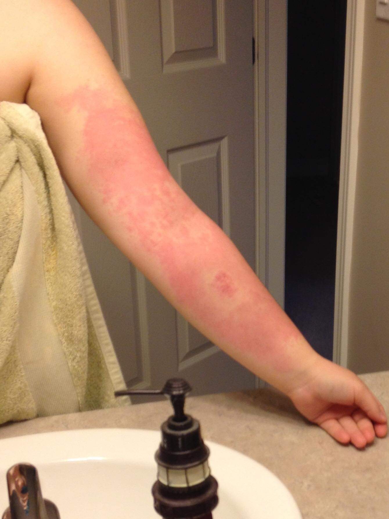 Lyme disease as cases rise, author details prevention, diagnosis and