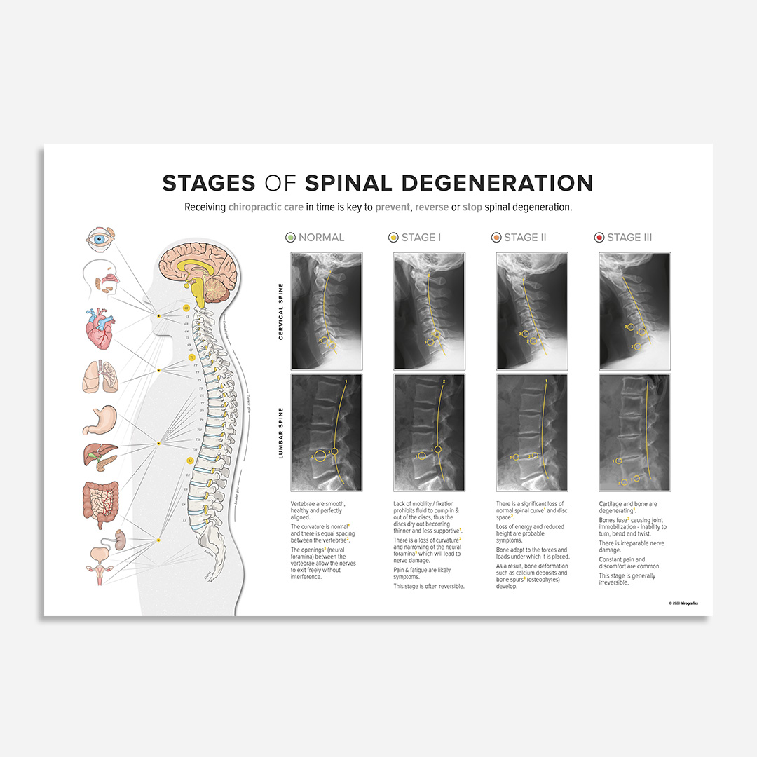 STAGES of SPINAL DEGENERATION Cx / Lx Kirografiks