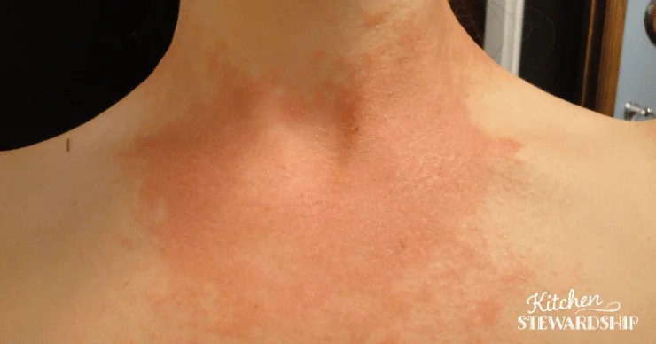 Candida Symptoms: Naturopath Vs. M.d. About The Surprise Rash