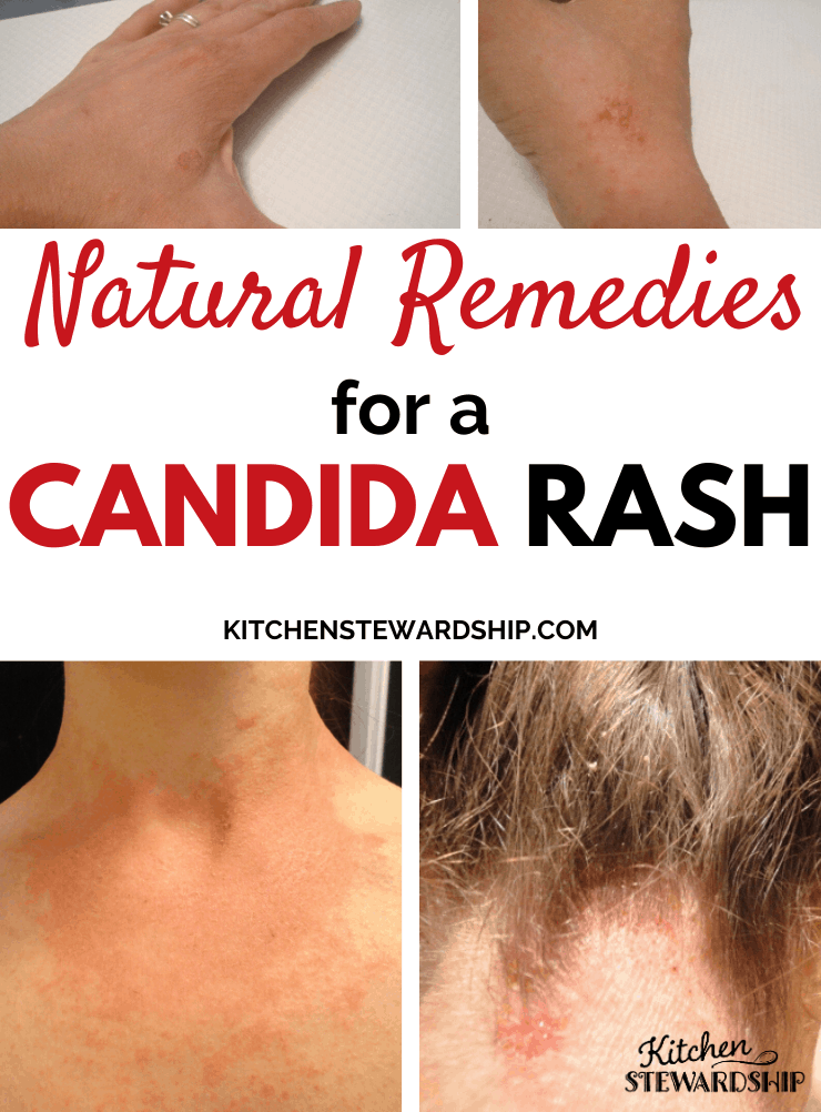 Candidiasis Rash