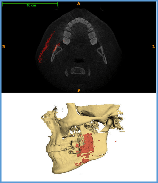 Kitware LeadingEdge Ultrasound Research