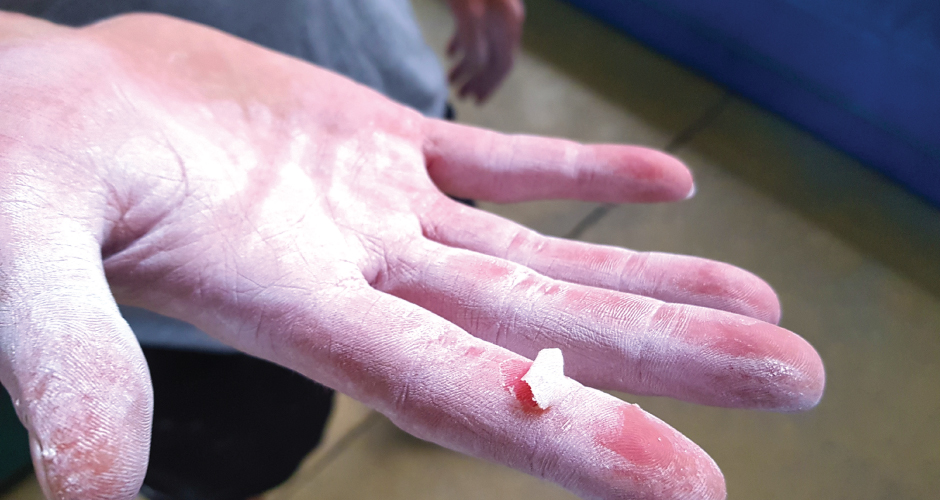 Aletas de cinta adhesiva cómo lidiar con lesiones en la piel de los