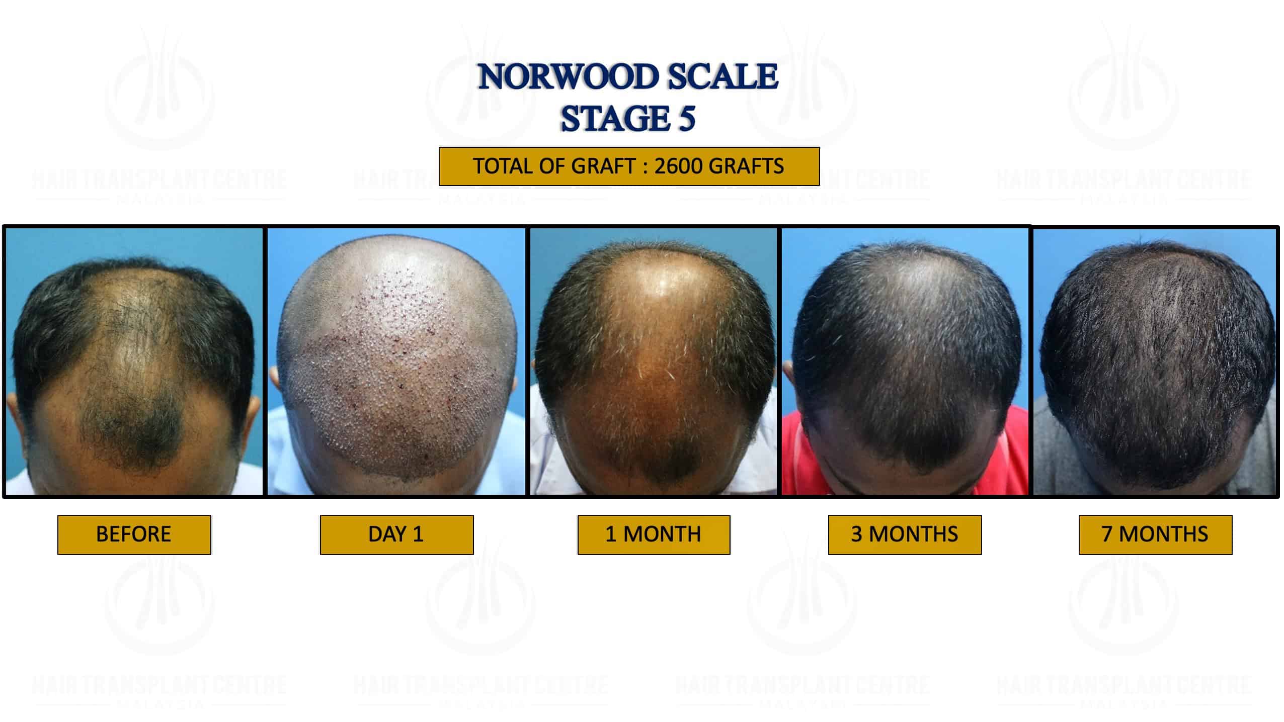 FUE Hair Transplant Hair Regrowh Treatment Safe and Proven Result